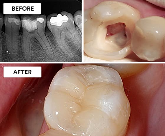 Root Canal Treatment